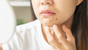 Top 5 lý do gây mụn dưới cằm – Nguyên nhân và cách phòng ngừa hiệu quả