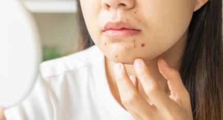 Top 5 lý do gây mụn dưới cằm – Nguyên nhân và cách phòng ngừa hiệu quả